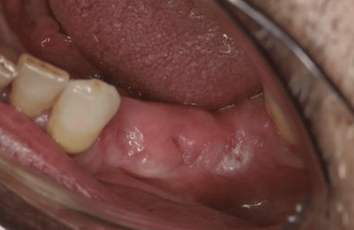A Periodontal Re-evaluation with a Surprising Finding